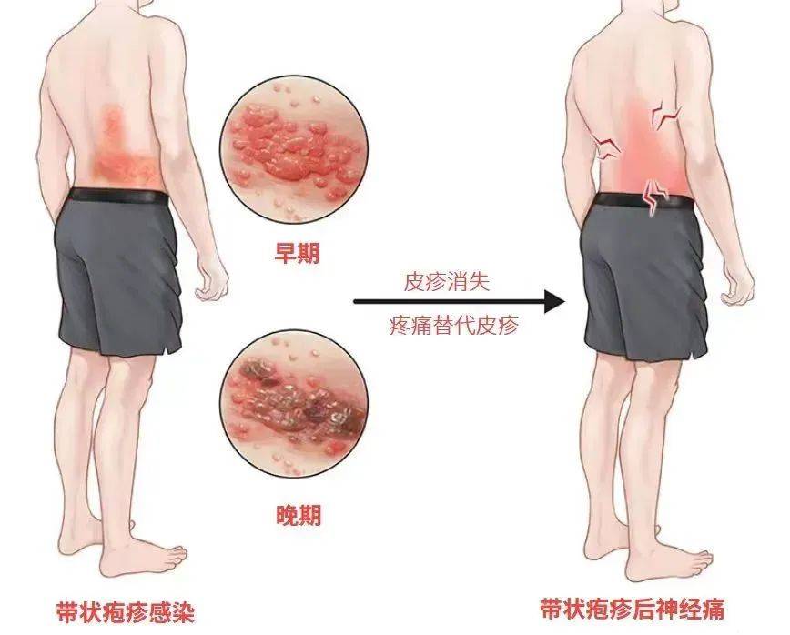 一旦感染终身携带<strong></p>
<p>aaa币行情</strong>！深圳疾控提醒：这4类人要注意
