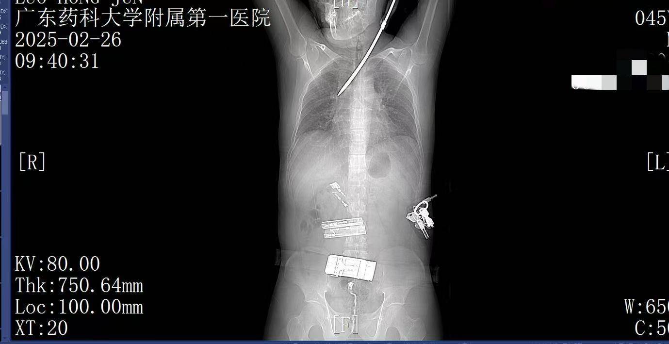 20米高空掉落螺丝刀直插男子胸腔<strong></p>
<p>上币保证金</strong>！医生：不要自行拔除
