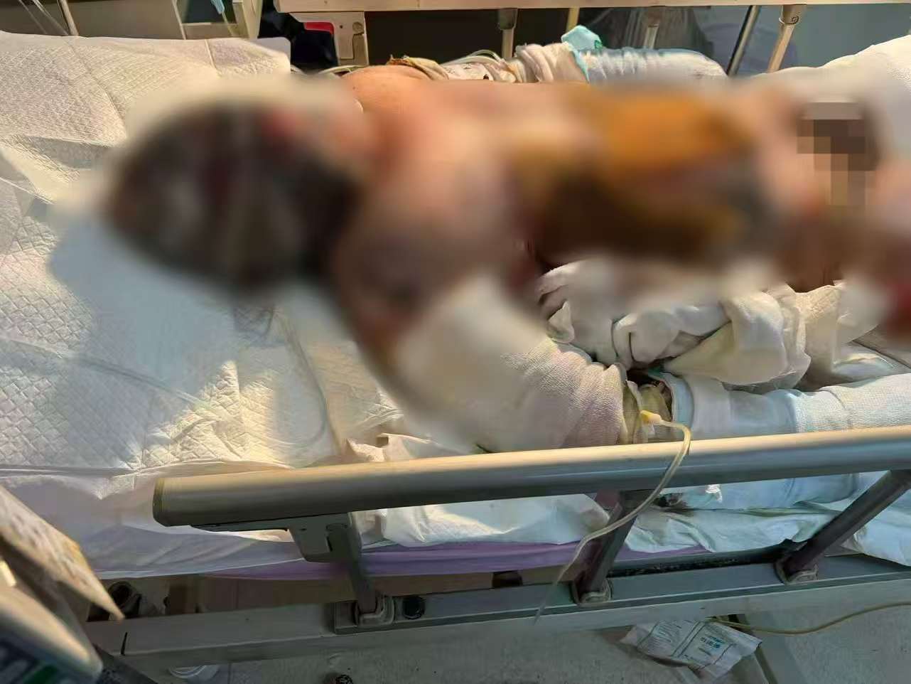 父子在哈尔滨一亲戚公司上班遇爆炸全身烧伤<strong></p>
<p>新华百货股票</strong>，治疗花费近百万公司拒赔偿？亲戚回应