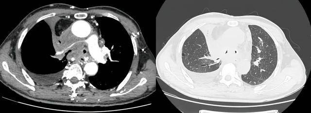 潍坊市第二人民医院完成首例气管支架、肺动脉覆膜支架同期植入术