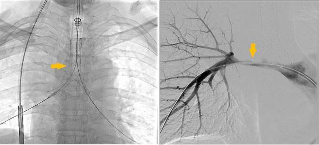 潍坊市第二人民医院完成首例气管支架、肺动脉覆膜支架同期植入术