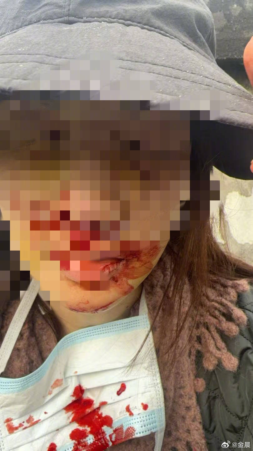 警方发布警情通报后<strong></p>
<p>顺发恒业股票</strong>，金晨晒脸部受伤照片并发文道歉